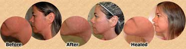 Valerie's Skin Needling